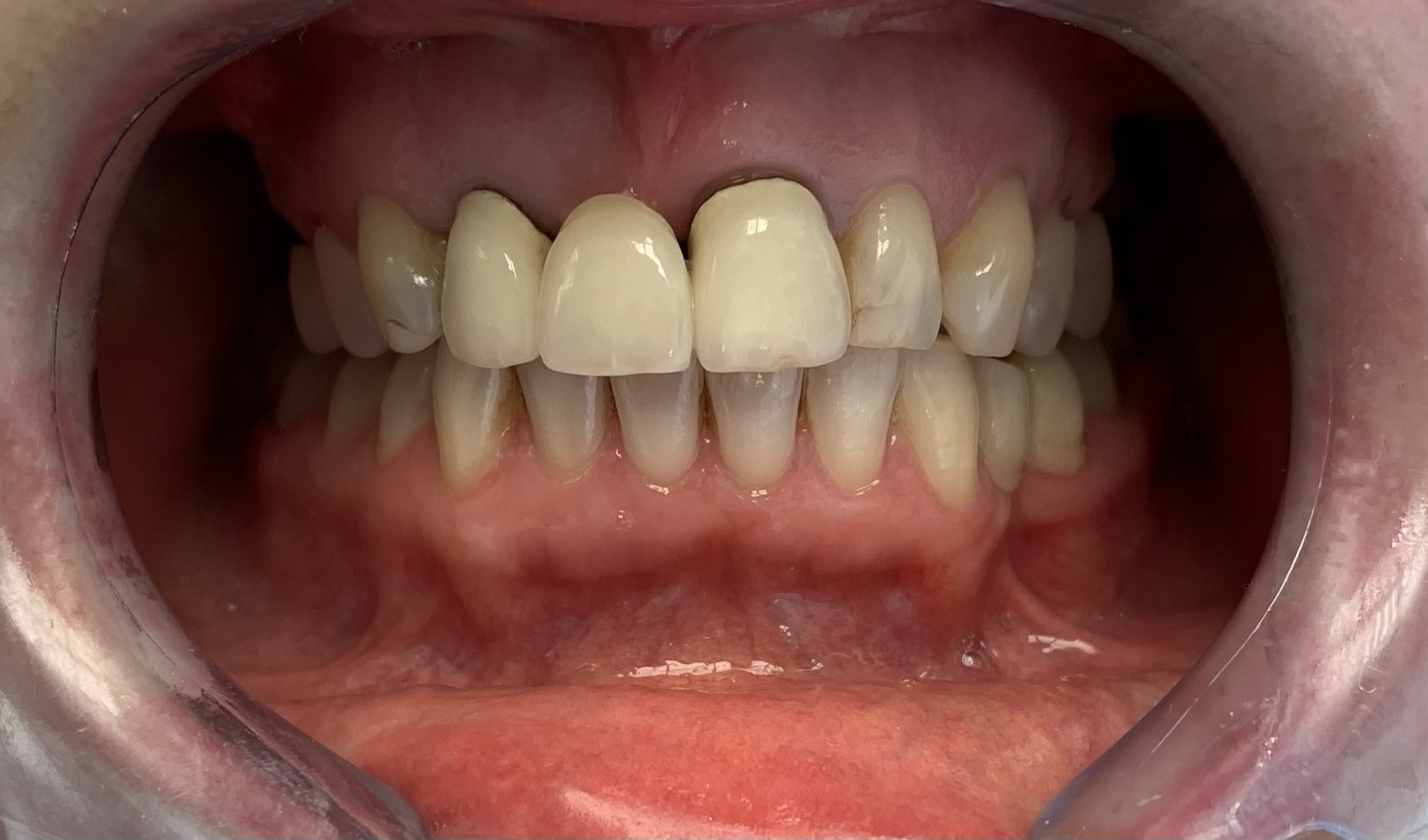 Ästhetische Zahnfüllung - Hospitadent